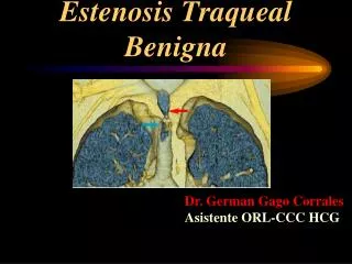 estenosis traqueal benigna