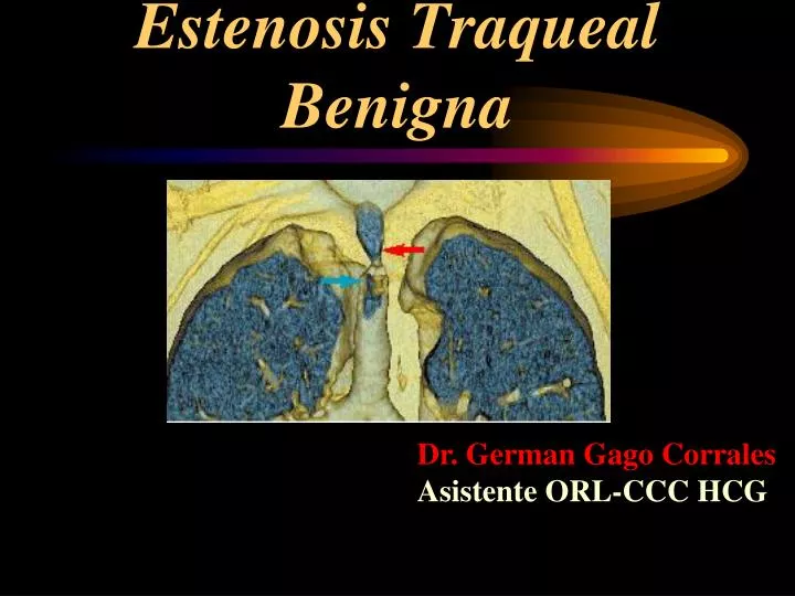 estenosis traqueal benigna