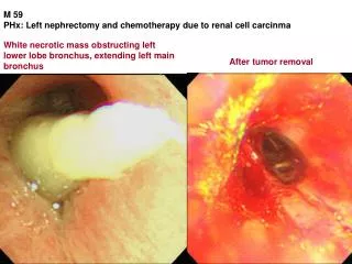 M 59 PHx: Left nephrectomy and chemotherapy due to renal cell carcinma