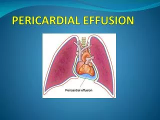 PERICARDIAL EFFUSION