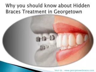 Why you should know about Hidden Braces Treatment in Georget