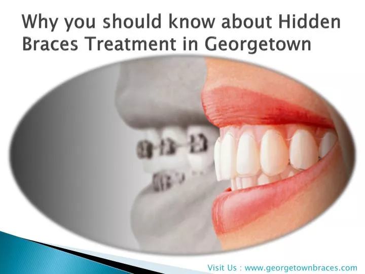 why you should know about hidden braces treatment in georgetown