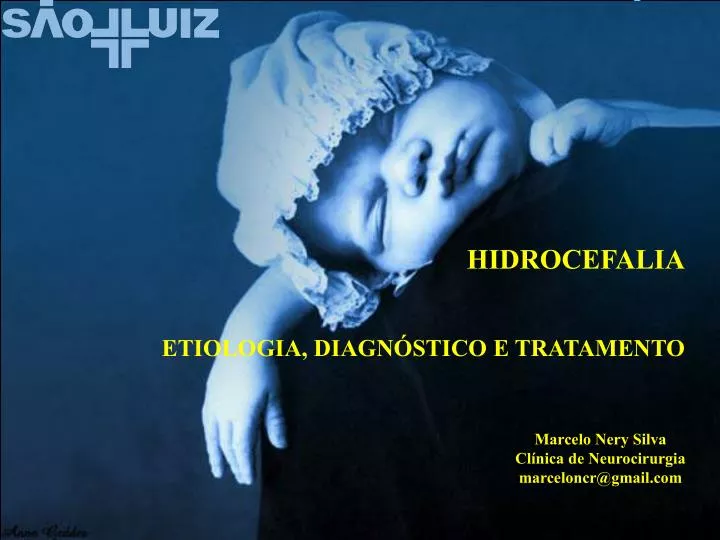 Ppt Hidrocefalia Etiologia DiagnÓstico E Tratamento Powerpoint Presentation Id4946679 9986