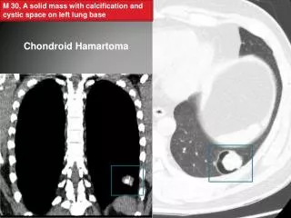 M 30, A solid mass with calcification and cystic space on left lung base