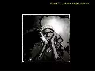 hansen ll simulando lepra histioide
