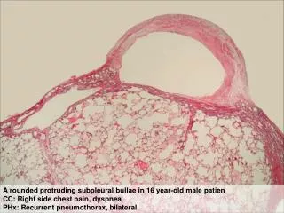 Thick pleural fibrosis due to repeated air leakage and inflammaion