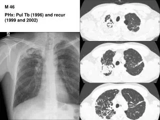 M 46 PHx: Pul Tb (1996) and recur (1999 and 2002)