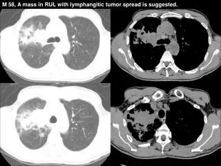 M 58, A mass in RUL with lymphangitic tumor spread is suggested.