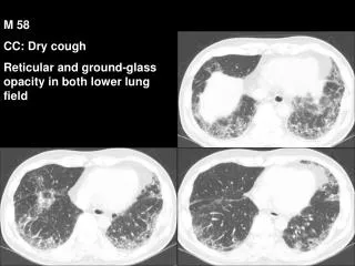 M 58 CC: Dry cough Reticular and ground-glass opacity in both lower lung field