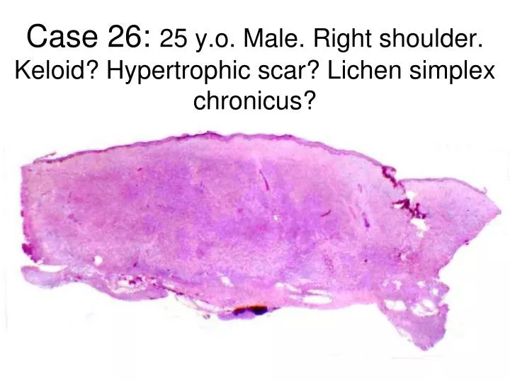 case 26 25 y o male right shoulder keloid hypertrophic scar lichen simplex chronicus