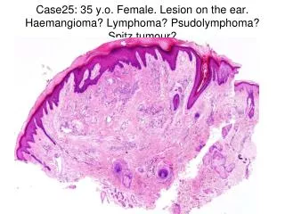 Case25: 35 y.o. Female. Lesion on the ear. Haemangioma? Lymphoma? Psudolymphoma? Spitz tumour?