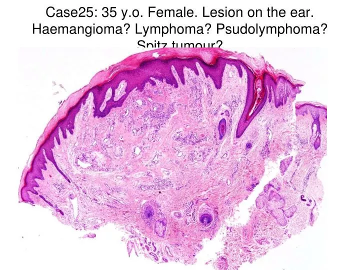 case25 35 y o female lesion on the ear haemangioma lymphoma psudolymphoma spitz tumour
