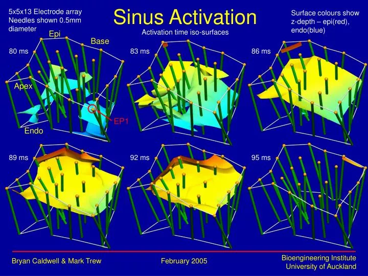 sinus activation
