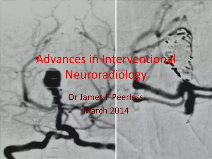 advances in interventional neuroradiology