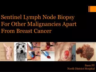 Sentinel Lymph Node Biopsy For Other Malignancies Apart From Breast Cancer