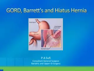 GORD, Barrett's and Hiatus Hernia