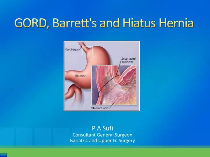 gord barrett s and hiatus hernia