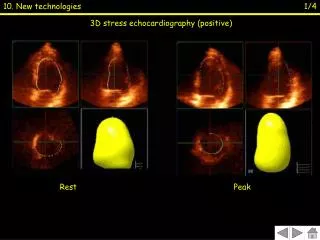 3D stress echocardiography (positive)