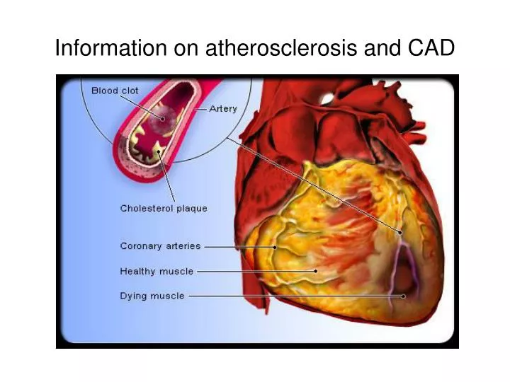 information on atherosclerosis and cad