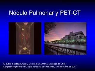 n dulo pulmonar y pet ct