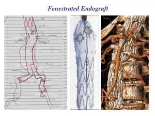 Fenestrated Endograft