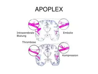 apoplex