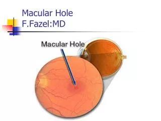 Macular Hole F.Fazel:MD