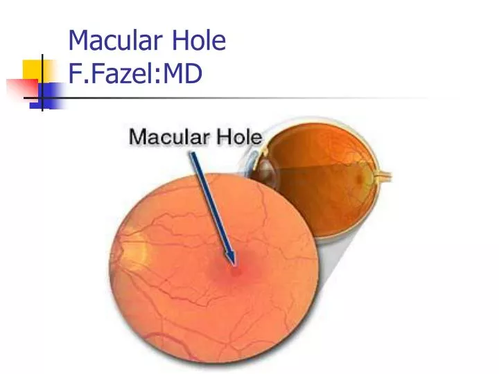macular hole f fazel md
