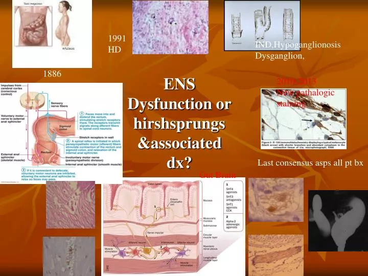 ens dysfunction or hirshsprungs associated dx