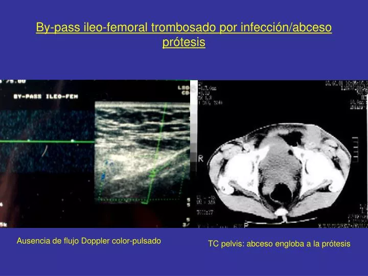 by pass ileo femoral trombosado por infecci n abceso pr tesis