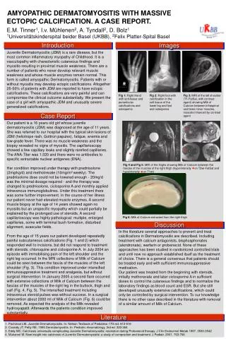 AMYOPATHIC DERMATOMYOSITIS WITH MASSIVE ECTOPIC CALCIFICATION. A CASE REPORT.