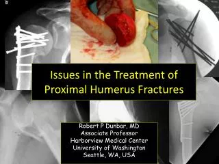 Issues in the Treatment of Proximal Humerus Fractures