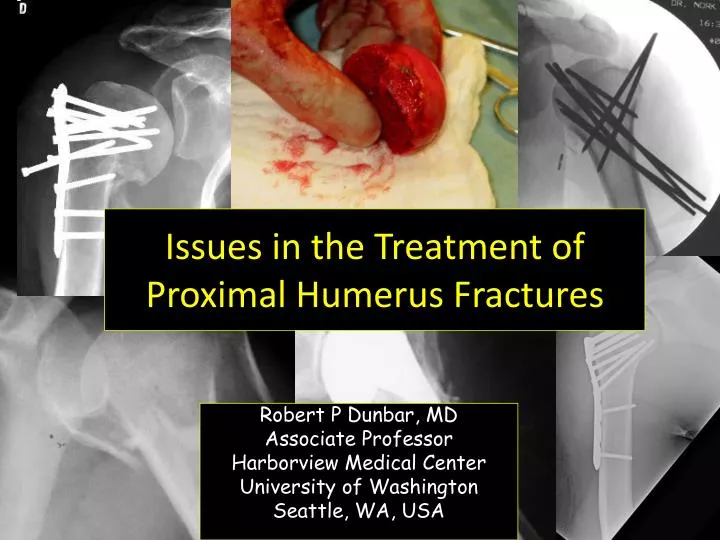 issues in the treatment of proximal humerus fractures