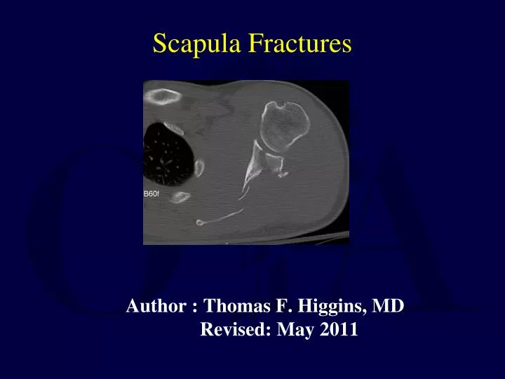 author thomas f higgins md revised may 2011