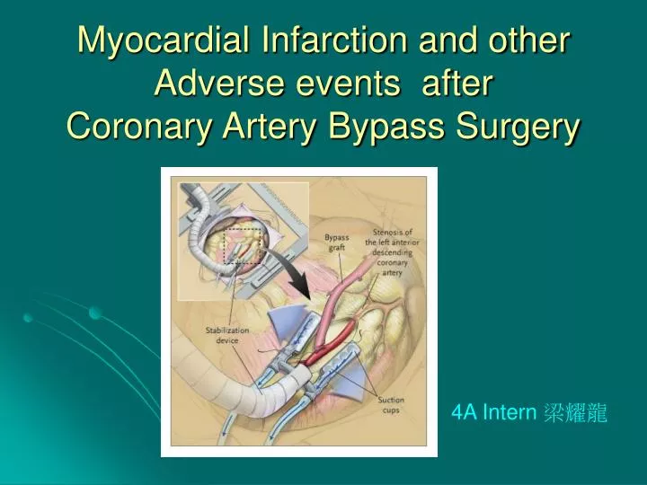 myocardial infarction and other adverse events after coronary artery bypass surgery