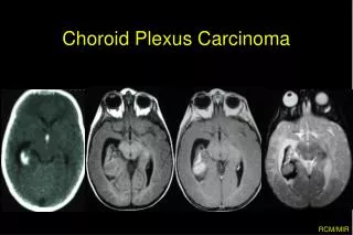 Choroid Plexus Carcinoma