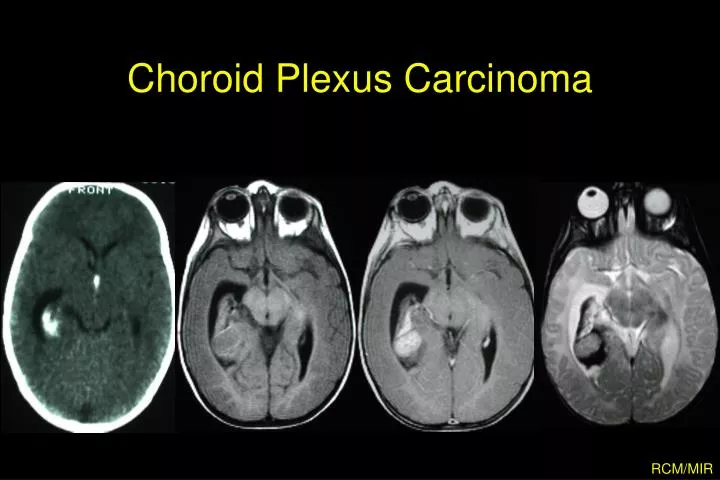 choroid plexus carcinoma