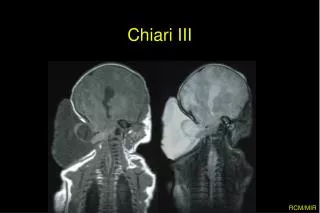 chiari iii