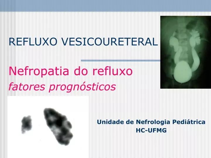 refluxo vesicoureteral nefropatia do refluxo fatores progn sticos