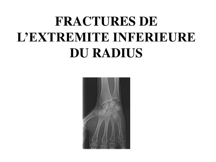 fractures de l extremite inferieure du radius