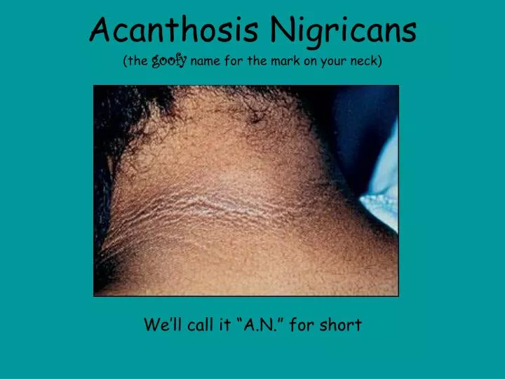 acanthosis nigricans the goofy name for the mark on your neck