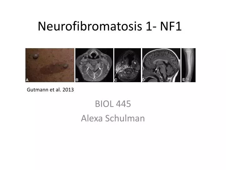 neurofibromatosis 1 nf1