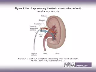 Figure 1 Use of a pressure guidewire to assess atherosclerotic renal artery stenosis