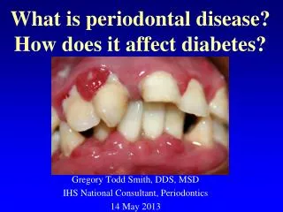 What is periodontal disease? How does it affect diabetes?