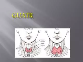 guatr