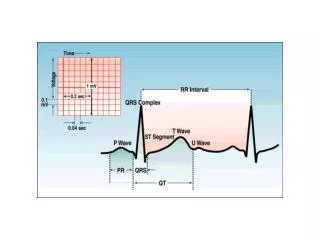 BAV completo: Dissociazione AV (pacemakers autonomi nodo seno e ventricoli)
