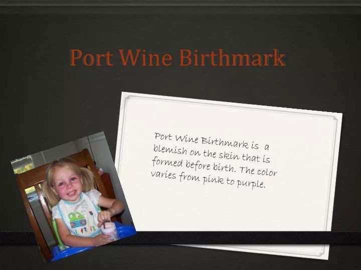 port wine birthmark