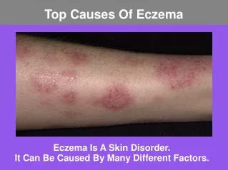 eczema is a skin disorder it can be caused by many different factors