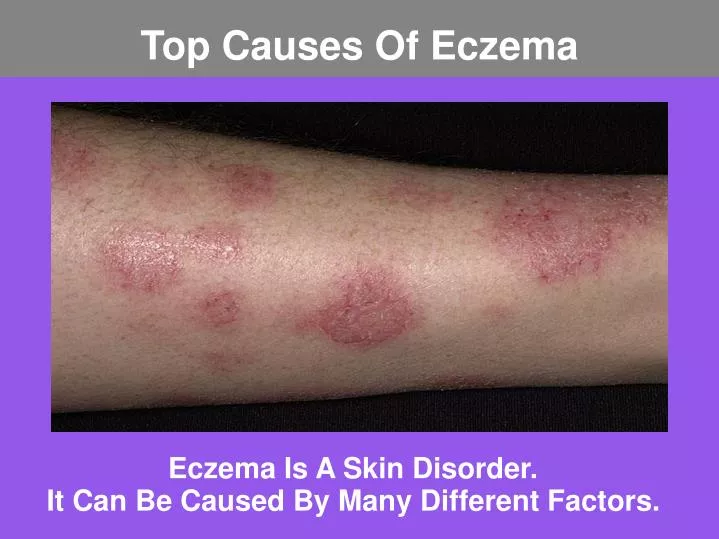 eczema is a skin disorder it can be caused by many different factors
