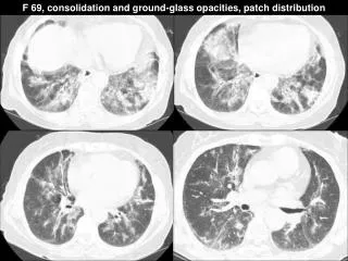 F 69, consolidation and ground-glass opacities, patch distribution